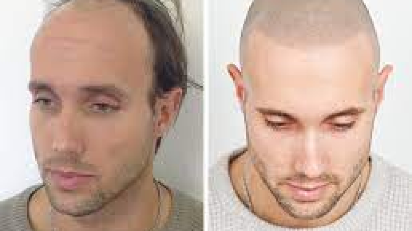 What are the Different Options for Men with Male Pattern Baldness?